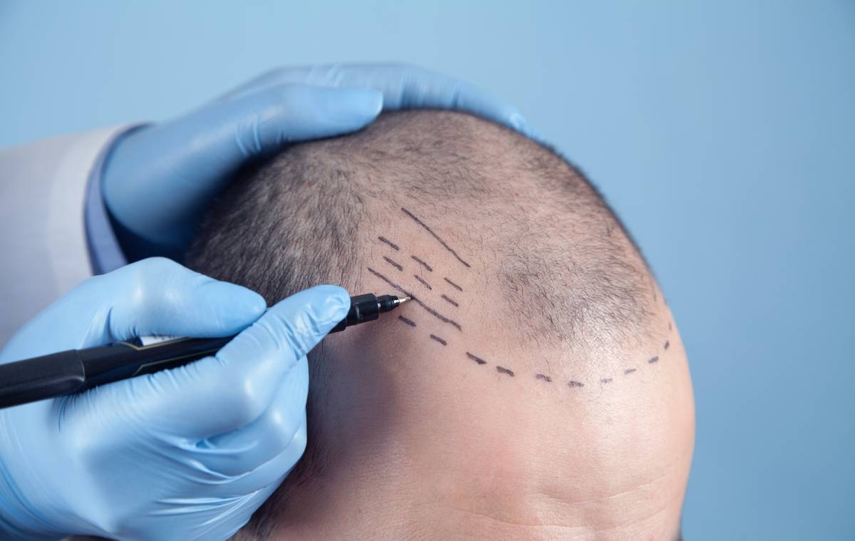 is-hair-loss-a-sign-of-diabetes-dr-hair